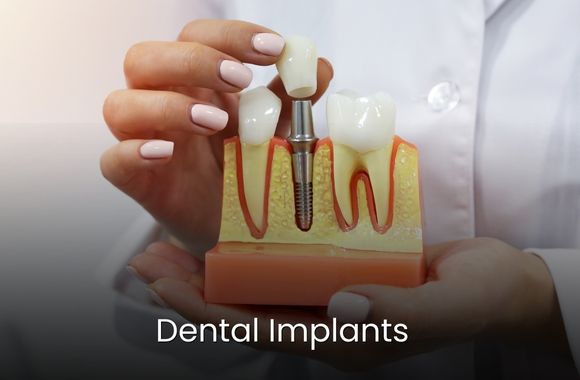 Dental Implants