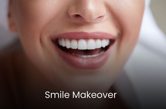 Smile-Makeover