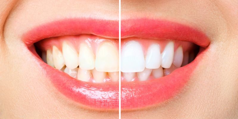 The-Ultimate-Guide-to-Teeth-Whitening-Achieve-a-Brighter-Smile-Naturally