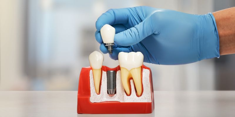 Dental-Implants