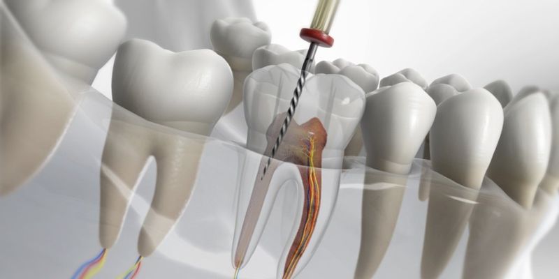 Root-Canal-Treatment